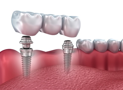 Nombreux avantages des prothèses sur implants dentaires