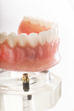 Implants dentaires ou dentiers