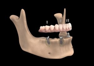 Perte osseuse dentaire et implants dentaires : possible?